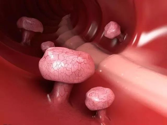 女会计查出肠息肉不在意，一年后竟然癌变了！