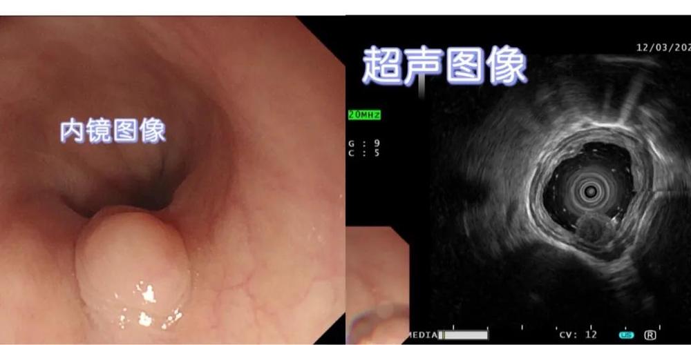 超声内镜：洞察消化道健康的“秘密武器”