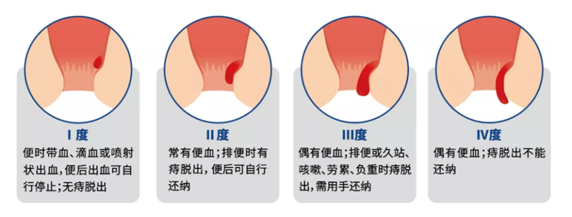 痔疮肉球脱出时，要注意什么？如何消除？