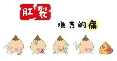 痛苦的难言之隐––肛裂