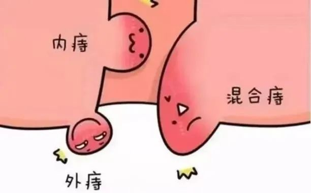 屁股那些“难言之隐”，肛肠疾病全解析
