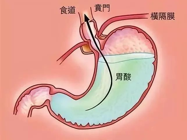 胃食管反流病的预防和日常保健