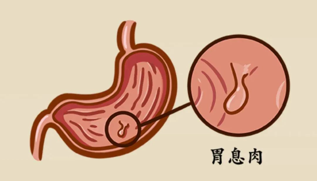 为什么长胃息肉？8个原因，建议尽量避免