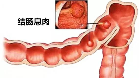 一次肠镜，就能保十年平安？医生说：不一定！         