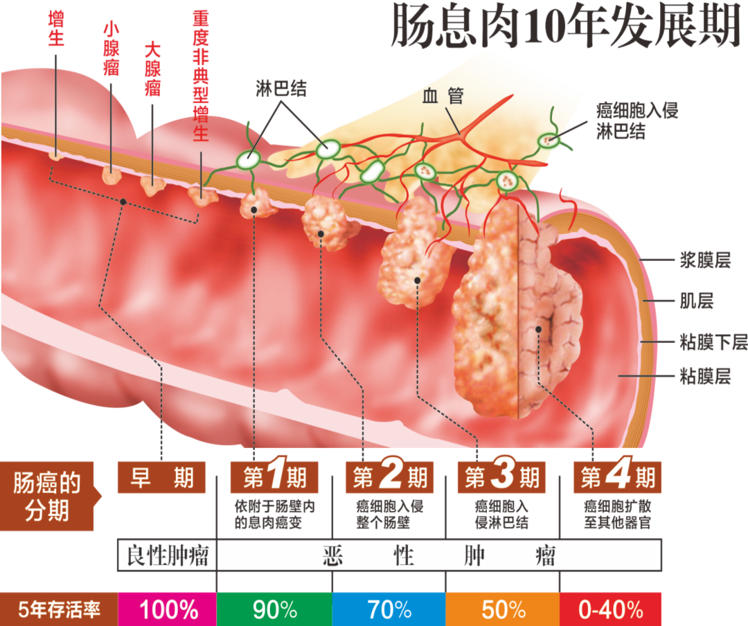为什么肠道容易长息肉？医生总结：大多与这几个原因有关