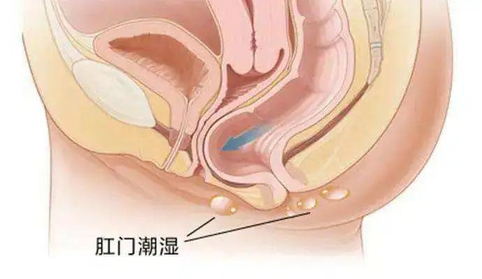 肛门周围潮湿有分泌物，多半是这7种原因！        
