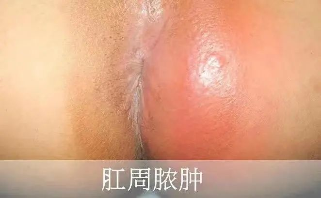 肛门长包，到底是囊肿还是脓肿，怎么分清？