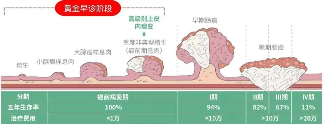 男子肠道长200多个息肉！医生提醒：从息肉到癌变仅4步→