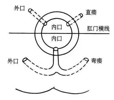 长了两个肛门？还会流脓、漏shi....