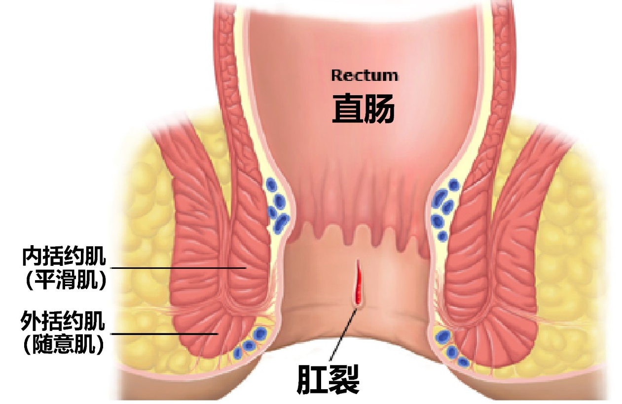 痔瘘裂专科｜30分钟微创根治，2小时离院！告别肛肠困扰so easy