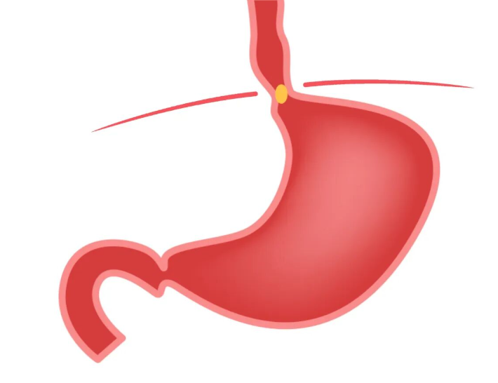 同样是反酸烧心、腹胀腹痛，为什么不是胃食管反流病？