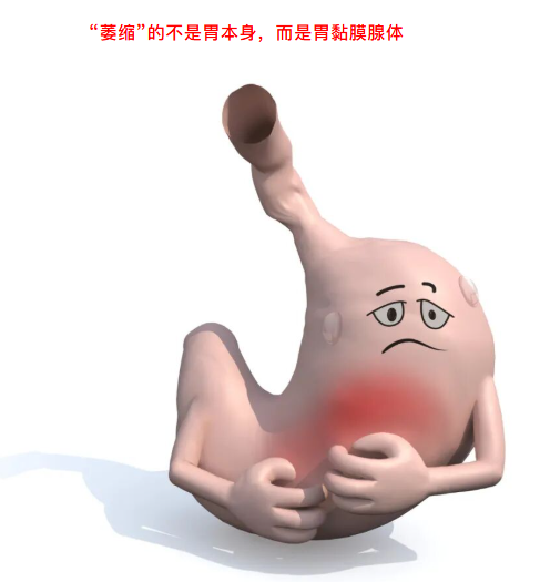 确诊萎缩性胃炎，是胃缩小了吗？